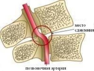 Синдром позвоночной артерии при шейном остеохондрозе: лечение, симптомы, причины