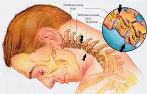 Можно ли умереть от остеохондроза шейного отдела: опасные признаки
