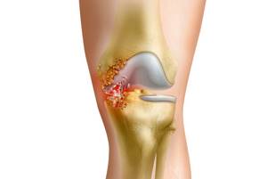 Гнойный артрит коленного и голеностопного суставов: симптомы и лечение
