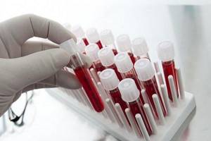 Анализ крови при ревматоидном артрите: биохимический профиль