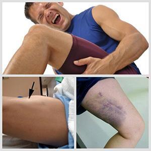 Растяжение мышц на ноге: причины, лечение и реабилитация