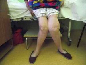 Остеоартроз коленного сустава 3 степени: лечение и операция