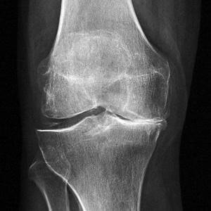 Замена коленного сустава, цена операции и реабилитации