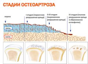 Остеоартроз локтевого сустава: симптомы, диагностика и лечение 1,2,3 степени