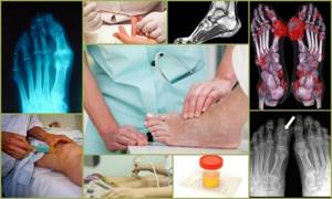 Подагрический артрит: лечение, симптомы, диета, фото, причины