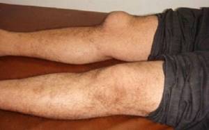 Воспаление коленного сустава: как снять и что делать
