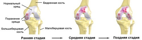 Гонартроз коленного сустава 1 степени: причины, симптомы, лечение