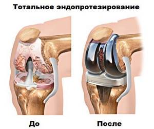 Контрактура коленного сустава: причины, симптомы и лечение