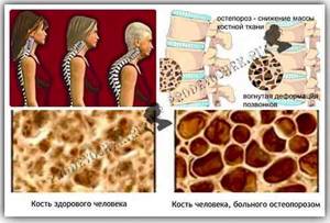 Остеопороз позвоночника: симптомы и лечение, причины