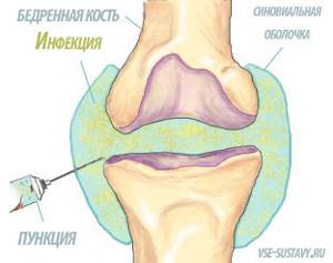 Инфекционный артрит коленного сустава: симптомы и лечение