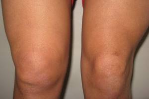 Синовит коленного сустава: симптомы, диагностика и лечение