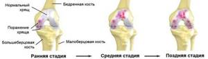 Артрит коленного сустава 1 и 2 степени: симптомы и лечение
