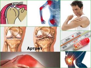 Инфекционный - септический артрит суставов: признаки и лечение