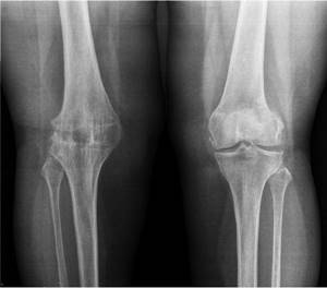 Артроз коленного сустава 4-й степени: лечение без операции не избежать