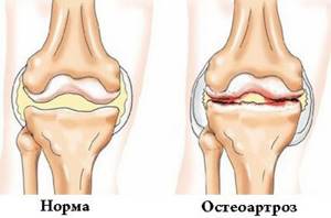 Остеоартроз коленного сустава 1 степени: лечение, симптомы
