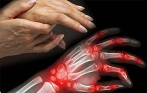 Артрит: симптомы и признаки, диагностика и лечение