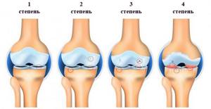 Остеоартроз коленного сустава 1 степени: лечение, симптомы