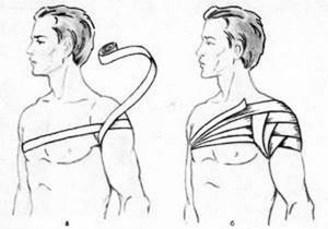Плексит плечевого сустава: симптомы, лечение плексита плечевого сплетения