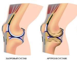 Артроз коленного сустава 3 степени: лечение, симптомы, причины