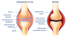 Ноющая боль в колене: причины, диагностика и лечение
