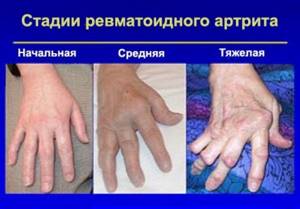 Чем лечить суставы пальцев рук в зависимости от заболевания