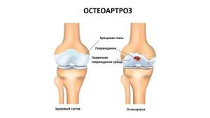 Остеоартроз суставов: симптомы, причины, лечение и стадии