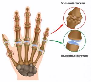 Перечень болезней суставов рук: симптомы и лечение