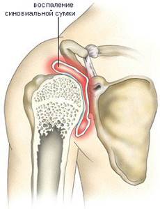 Вывих плеча (плечевого сустава): привычный вывих, подвывих - лечение