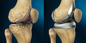 Остеоартроз коленного сустава: симптомы и лечение, причины, степени