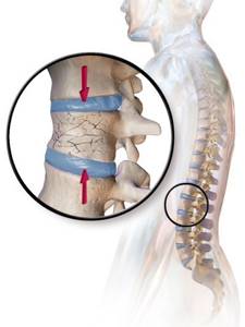 Диффузный остеопороз костей, поясничного отдела и позвоночника