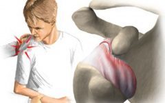 Растяжение связок плечевого сустава (плеча): симптомы, лечение