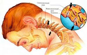 Обострение шейного остеохондроза: симптомы, первая помощь, лечение