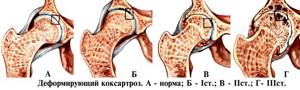 Деформирующий остеоартроз тазобедренного сустава 1-2 степени. Лечение