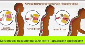 Лечение остеопороза у пожилых женщин: препараты, диета, народные средства