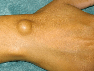 Гигрома запястья (лучезапястного сустава кисти): симптомы, лечение