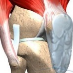 Лигаментоз крестообразных связок коленного сустава: лечение и профилактика