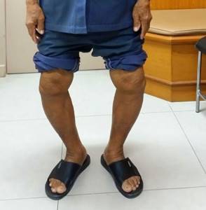 Двусторонний гонартроз коленного сустава, степени и виды лечения