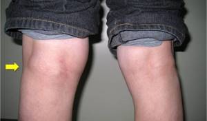 Гигрома коленного сустава: симптомы и лечение