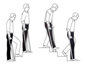 Упражнения после эндопротезирования коленного сустава