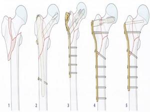 Видео: лечение и профилактика переломов шейки бедренной кости
