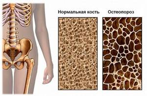 Разница между остеопенией и остеопорозом: перечень отличий