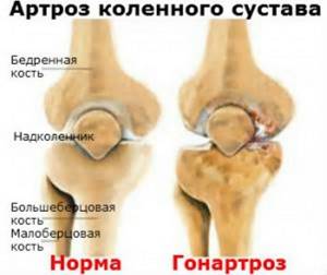 Остеоартроз коленного сустава 2 степени: лечение, причины, симптомы