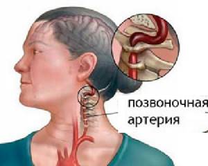 Синдром позвоночной артерии при шейном остеохондрозе: лечение, симптомы, причины
