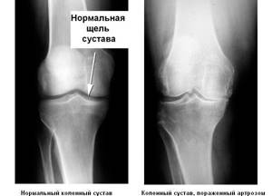 Артроз коленного сустава: симптомы и лечение, что такое, как лечить