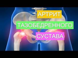 Артрит тазобедренного сустава: симптомы и лечение, как лечить дома