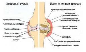 Замена коленного сустава: этапы операции, показания и подготовка