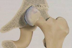 Разрушение тазобедренного сустава: причины, симптомы, лечение