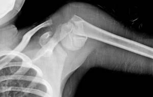 Видео: переломы проксимального отдела плечевой кости. А.А. Волна (Москва)