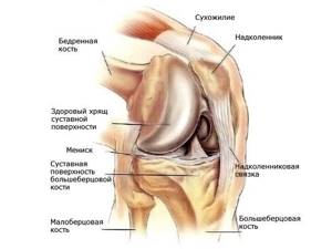 Деформирующий артроз коленного сустава: симптомы, лечение 1, 2, 3 степени