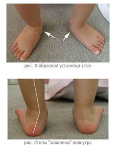 Вальгусная деформация стопы у детей: фото, лечение, причины, симптомы